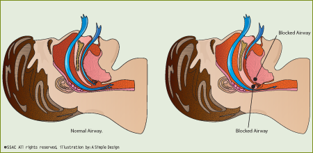 illustration of Snoring